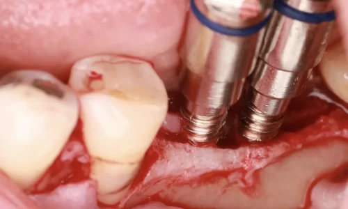 Regeneración Ósea Esencial